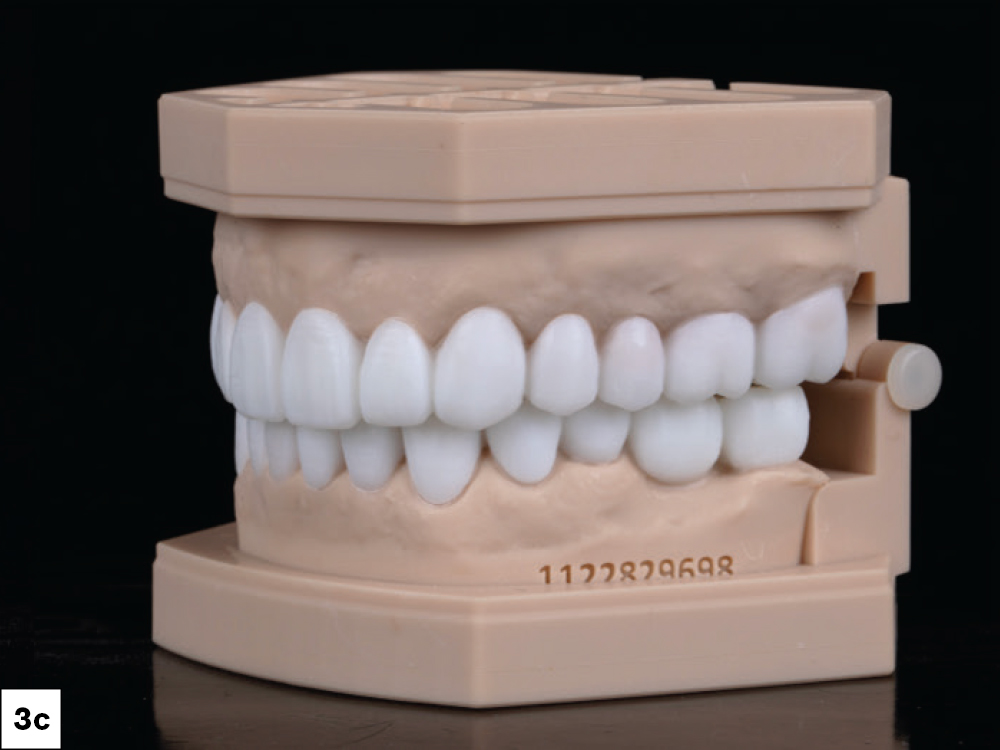 Lateral view of full-mouth diagnostic wax-up on articulated stone models showing planned occlusion from the opposite side.