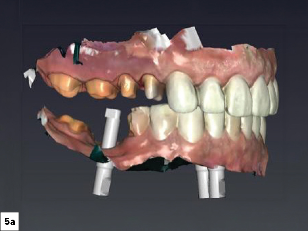 3D intraoral scan showing maxillary posterior preparations alongside scan bodies seated on mandibular implants, lateral view.