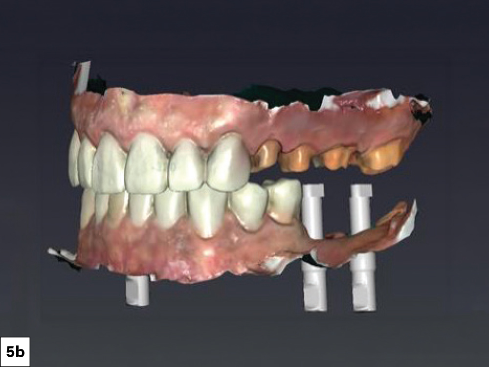 3D intraoral scan showing both arches with anterior provisionals in place and scan bodies on mandibular implants, facial view.
