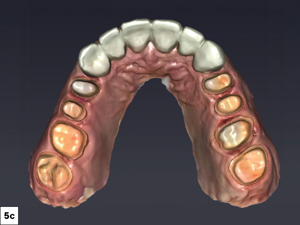 3D intraoral scan occlusal view of the maxillary arch showing posterior crown preparations with margin lines alongside seated anterior provisionals.