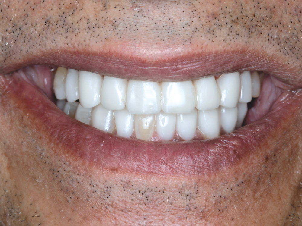 Facial view of a patient's smile with a bis-acryl mock-up in place for esthetic and functional evaluation.