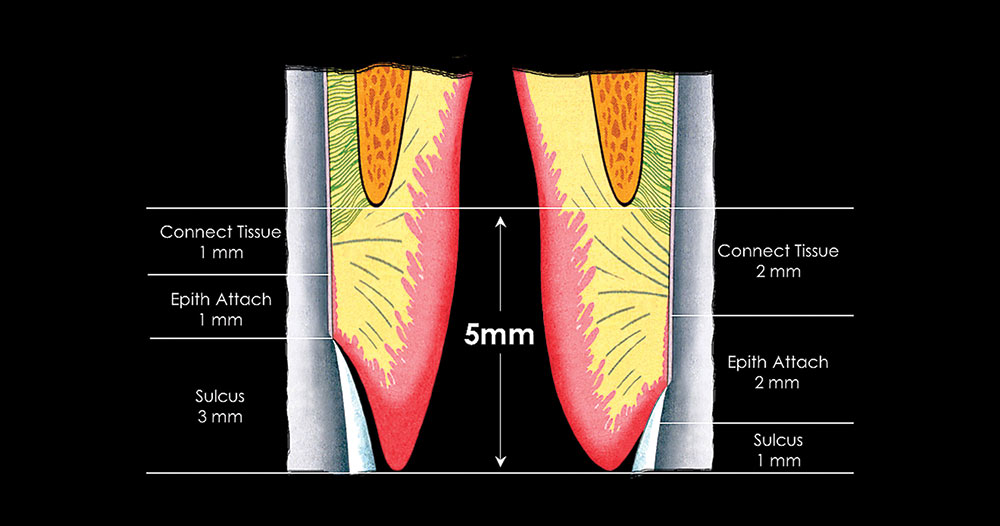 Using Margin Placement to Achieve the Best Anterior Restorative Esthetics