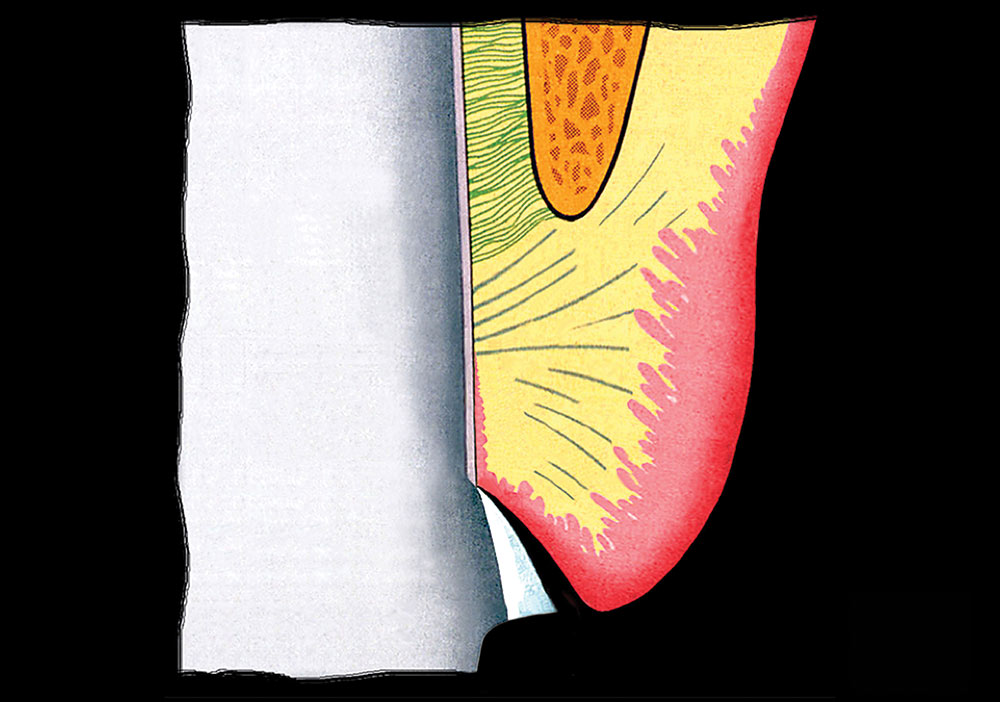Using Margin Placement to Achieve the Best Anterior Restorative Esthetics