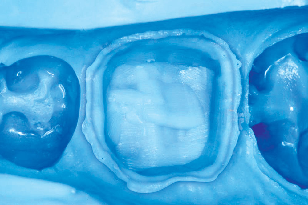 Clinical Predictability with Dual-Arch Impressions: Plastic Trays Are ...