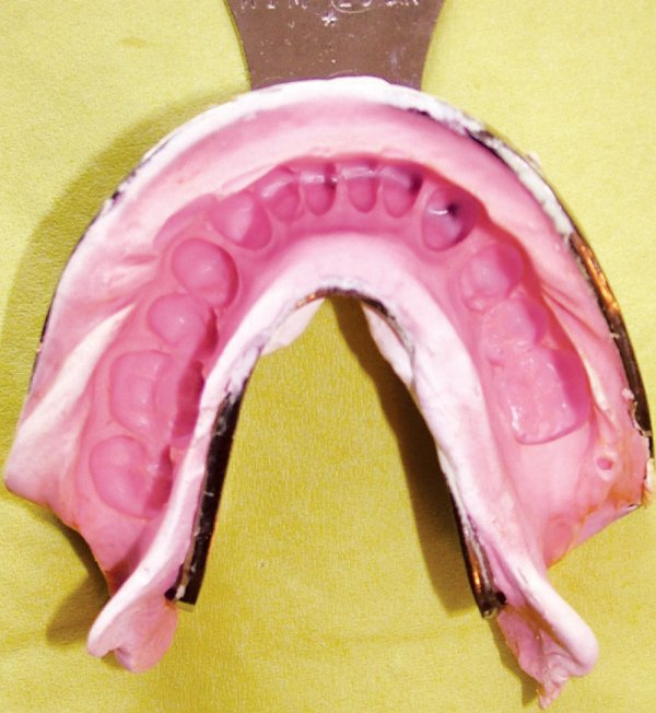 Alginate Substitutes Rationale for Their Use