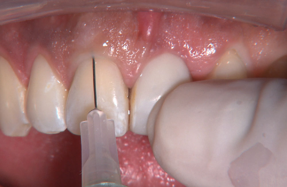 Bruixir Express Number The IOS FastScan™ for an Anterior BruxZir® Bridge