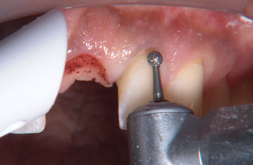 Bruixir Express Number The IOS FastScan™ for an Anterior BruxZir® Bridge