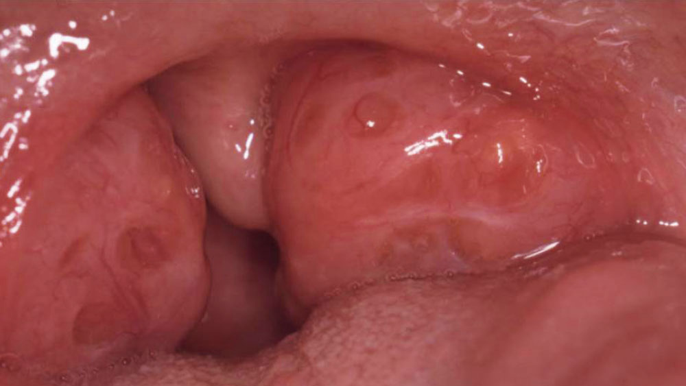 Grade 4 enlarged tonsils