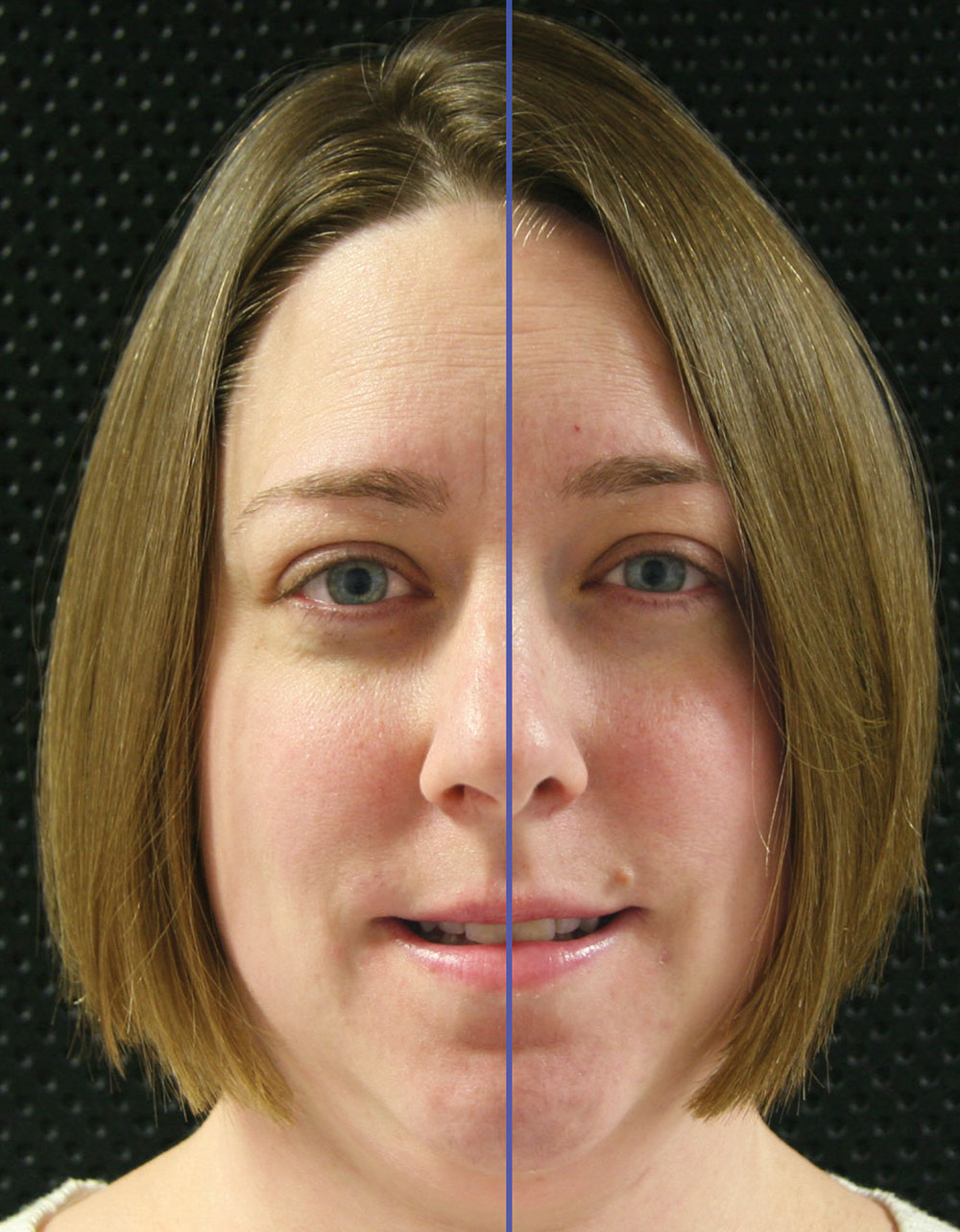 Simplifying Laboratory Communication The Dental Midline Position