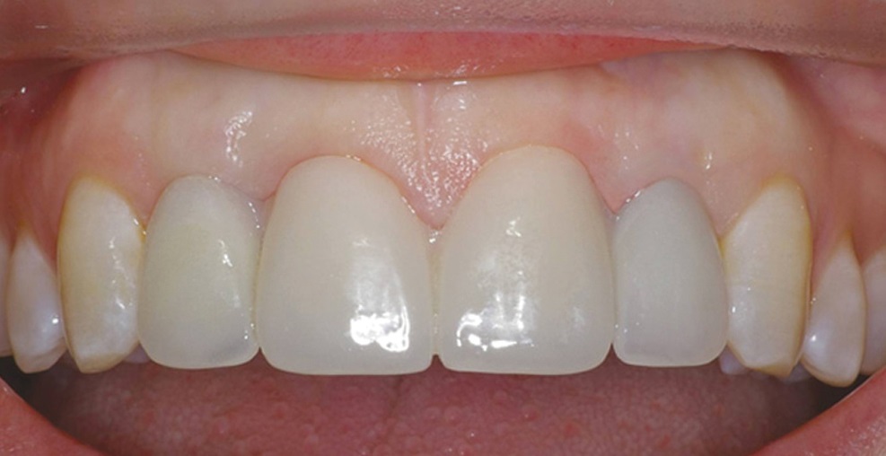 Bio Temps provisionals by Glidewell Laboratories