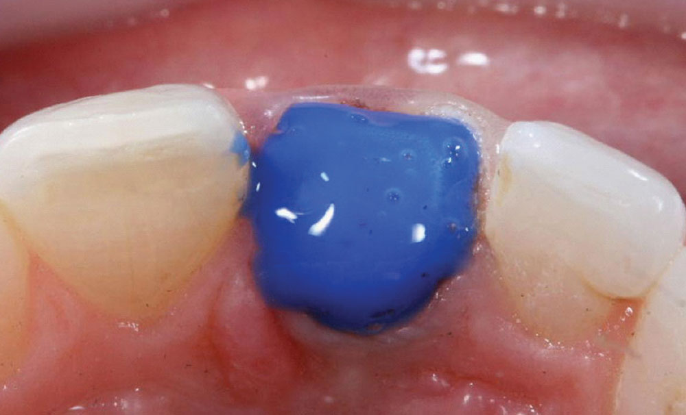 Aesthetic Treatment of Dark Root Syndrome