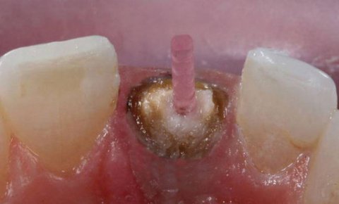 Aesthetic Treatment of Dark Root Syndrome