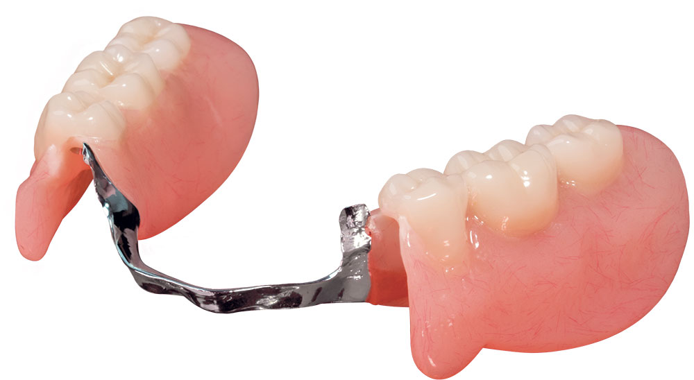 image of a partial denture
