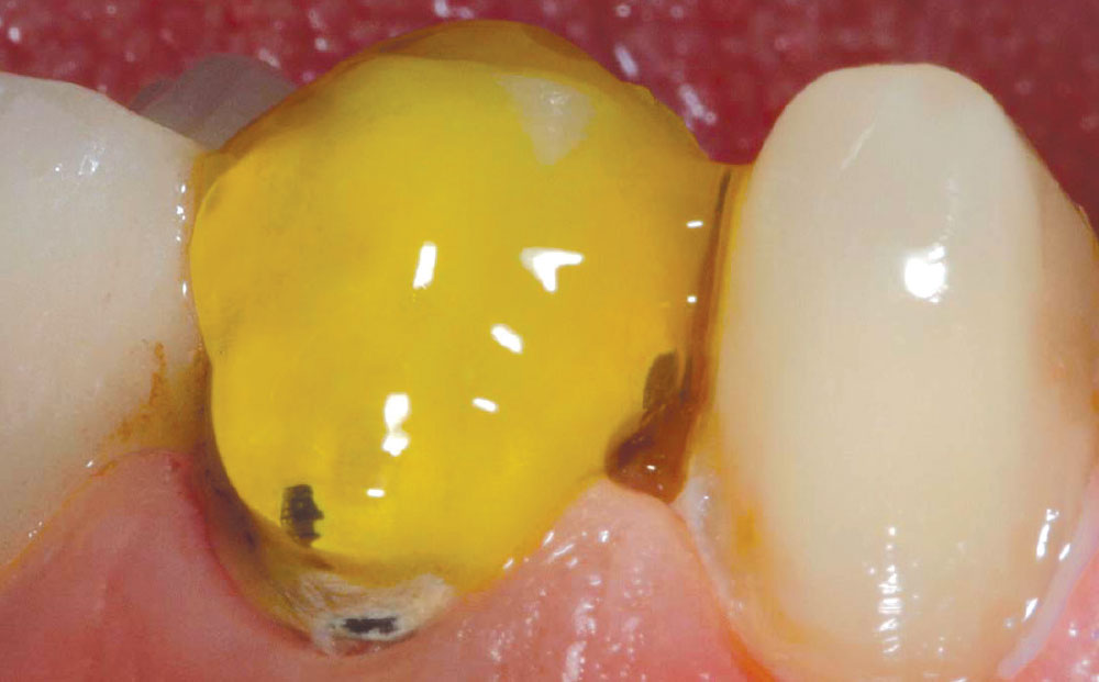Image showcasing Repair, Don't Replace - Part 1: Resurfacing an Existing Porcelain Fused ...