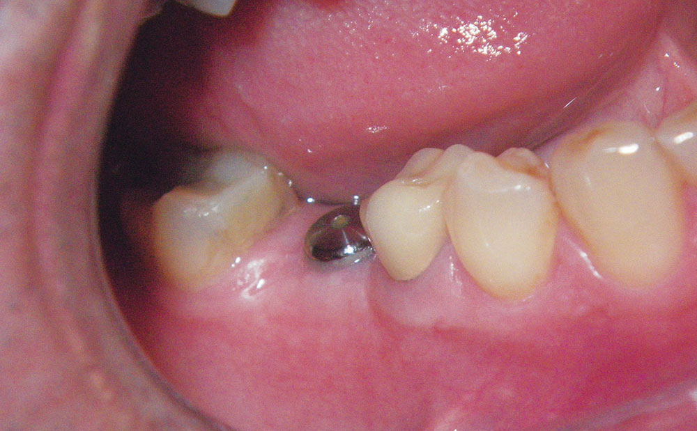 Scannable Abutments Digital Impressions for Dental Implants