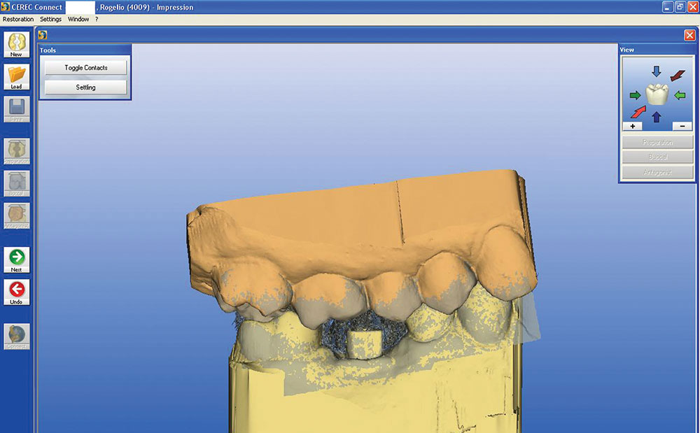Scannable Abutments Digital Impressions for Dental Implants