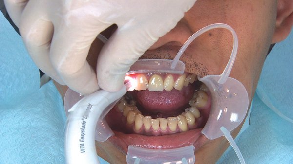 Bruixir Express Number The Pursuit of BruxZir Anterior Esthetics