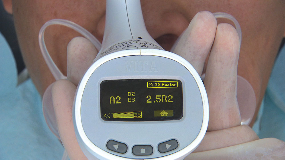 Bruixir Express Number The Pursuit of BruxZir Anterior Esthetics