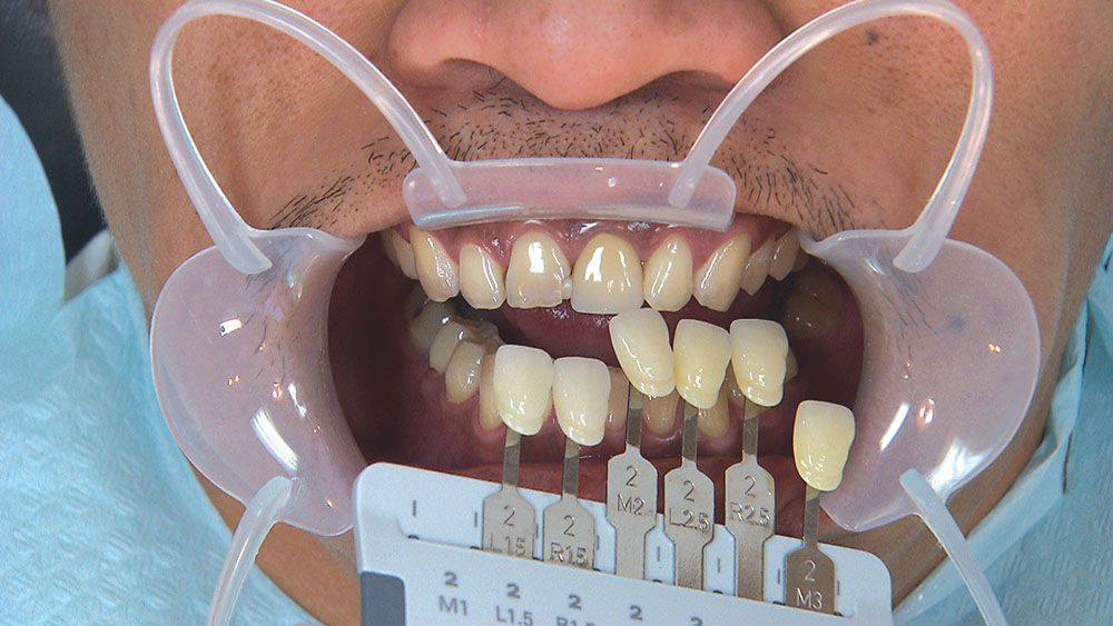 Bruixir Express Number The Pursuit of BruxZir Anterior Esthetics