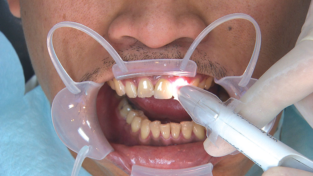 The Pursuit of BruxZir Anterior Esthetics
