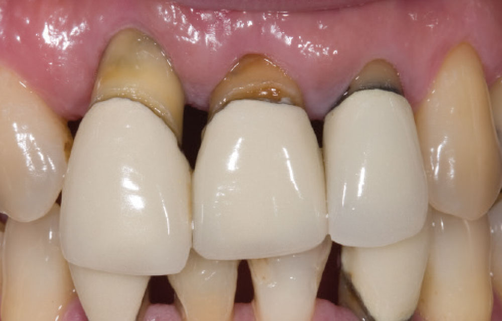 Teeth with periodontal disease
