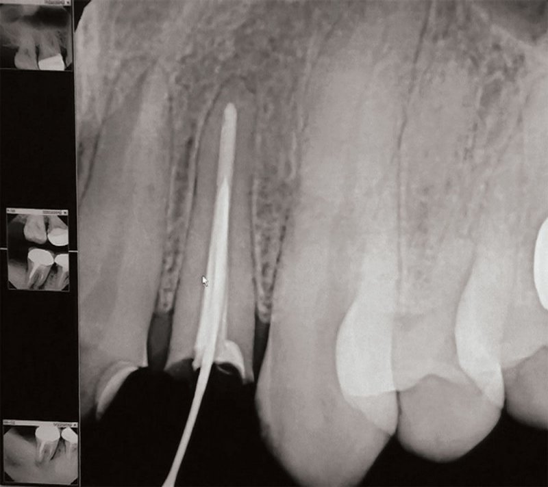 Post-and-Core Technique for Endodontically Treated Teeth