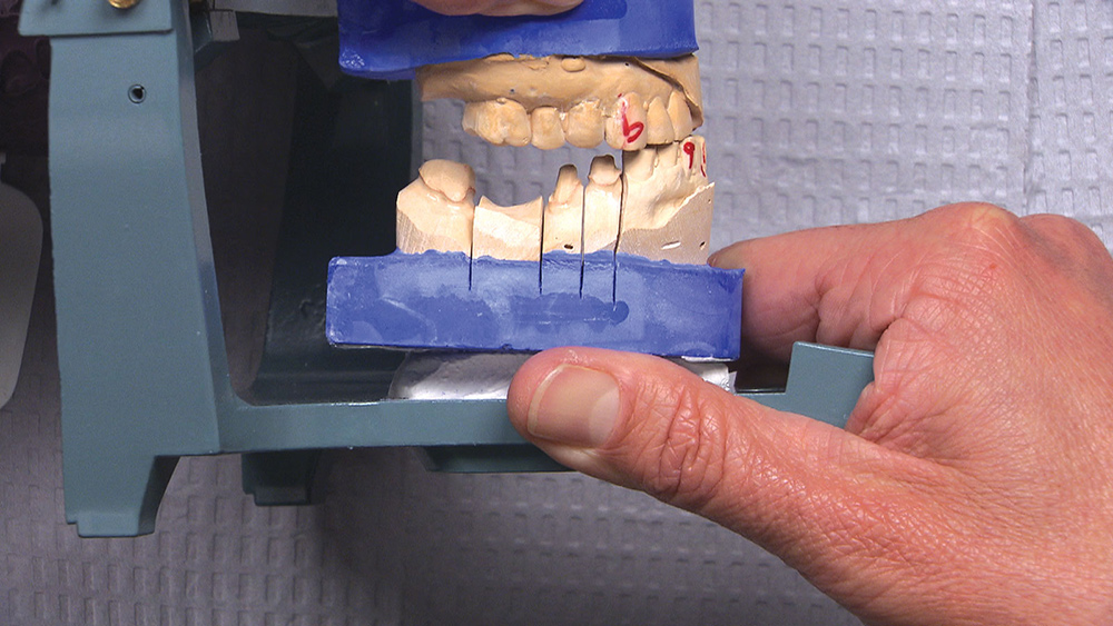 Figure 10: A little twist of the articulator brings the other two anterior teeth into contact, but now there is a huge gap between the posterior teeth. Again, there is no way to verify where the bite is correct. If only we had a full-arch impression on the upper and the lower, we could take an educated guess.
