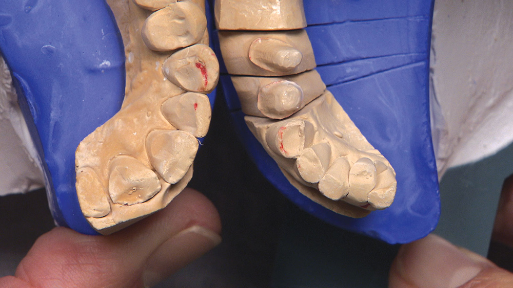 Figure 11: Look at all these wonderful wear facets; usually, these make it a no-brainer for us to hand articulate a case. Even a separate bite registration over the preps could have saved this impression — if you ignore the fact that many bridges made from double-arch trays don’t fit. Bottom line: This case needs to go back to the doctor for new, full-arch impressions.
