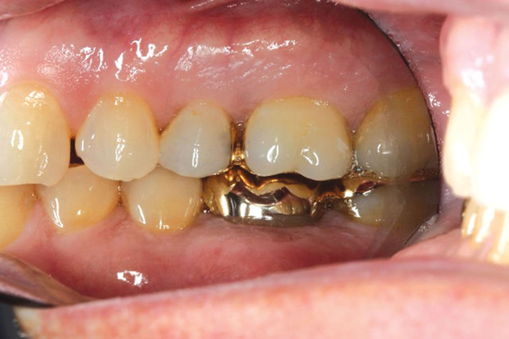 Figure 1: This patient will undergo a maxillary full-arch restoration to correct occlusal issues and mild periodontal disease. When performing definitive restorative procedures, it is critical to have an ideal periodontal foundation to restore. There was an initial discussion on whether to restore the bicuspids. After review of occlusal issues, it was decided to include the bicuspids in the provisional phase of treatment.