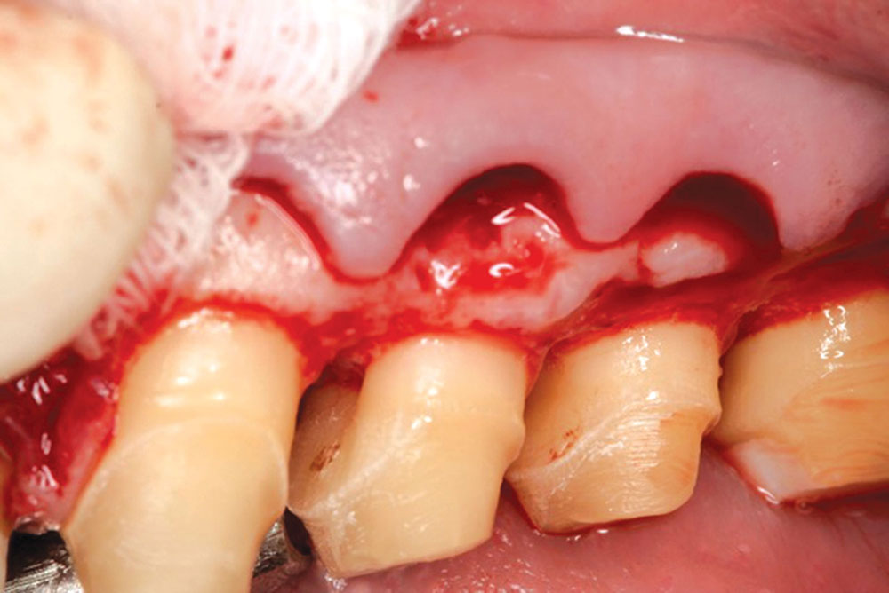 Figure 2: Upon reflection of the tissue with a full-thickness flap due to the existing thick bone, the tooth surfaces exhibited calculus located in concavities.