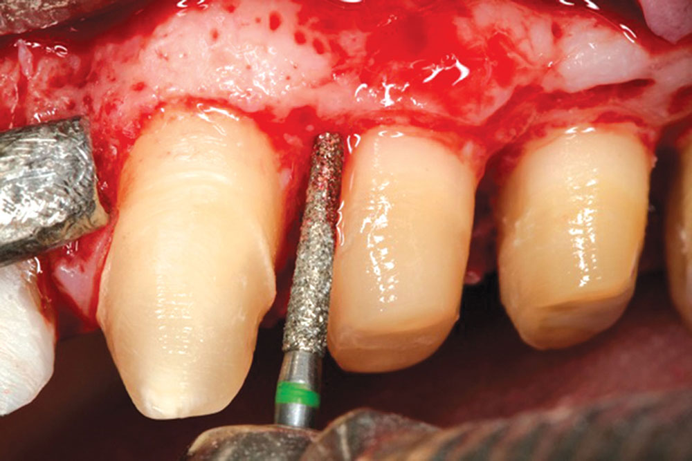 Figure 4: Using a C847-016 diamond bur (Axis Dental; Coppell, Texas), the tooth surface is gently smoothed to remove any irregularities of the root surface, as well as all CEJs. The concavity on the upper first bicuspid is also removed by gently blending the line angles approximating the concavity. Removal of the middle tooth surface of the bicuspid was avoided so as not to deepen the concavity.