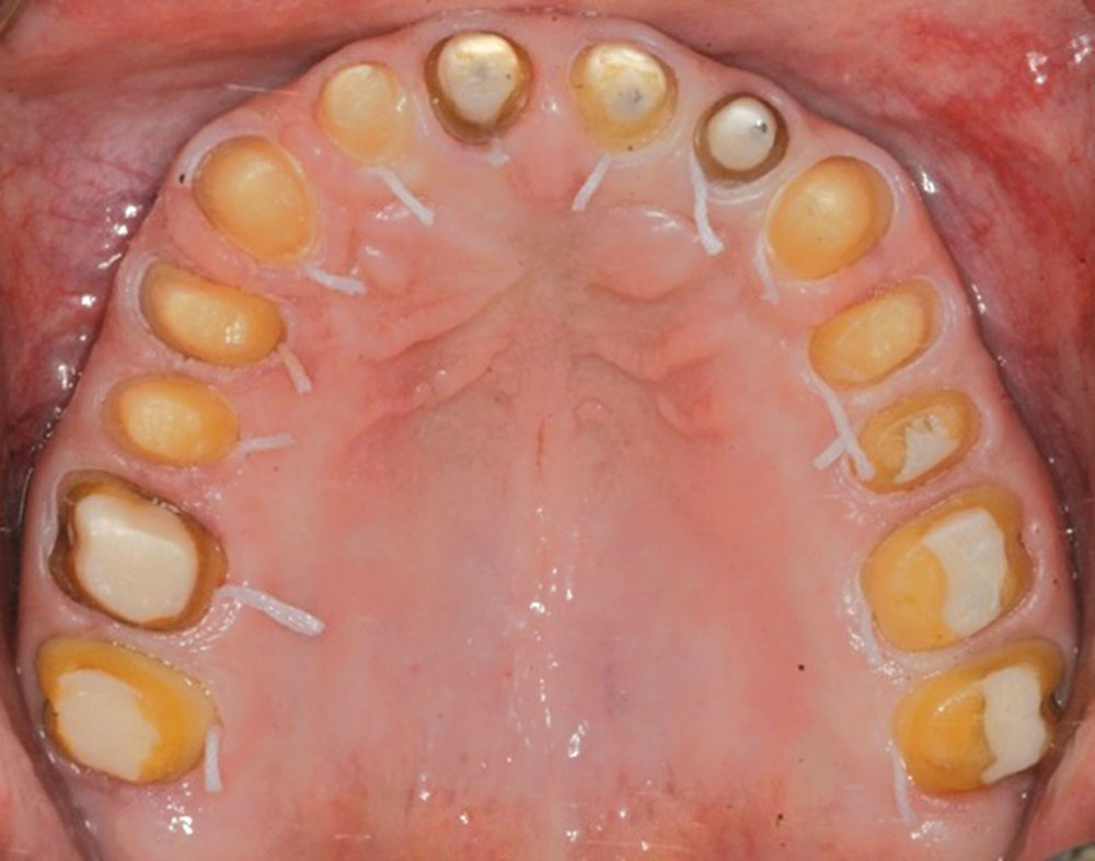 Figure 11: Impressions day, 12 weeks post-op. All margins are placed just coronal to the gingival collars. A size 7/00 SilTrax® cord (Pascal International; Bellevue, Wash.) is placed in the sulcus to allow for the lab technicians to trim the dies.