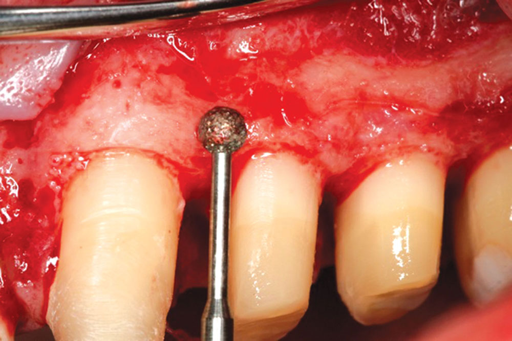 Figure 6: A C801L-023 diamond round bur (Axis Dental) is then used to properly contour the bone to mimic the soft tissue. The term for this procedure is “creating a parabolic architecture,” and it is the key to forming an ideal interface between bone, tooth and tissue. This phase of the surgery helps to avoid the formation of pockets between the bone and soft tissue when the tissue is replaced.