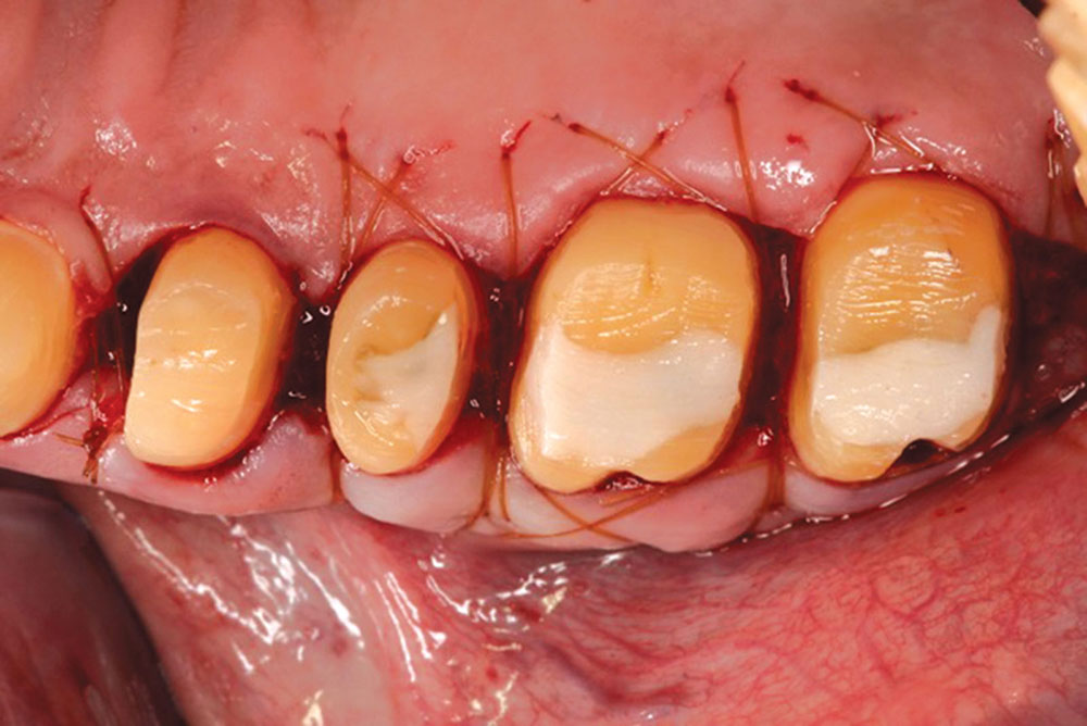 Figure 9: An occlusal view showing as much primary closure of the flaps as possible. This allows for decreased discomfort in the healing phase. Also note that no CEJs are present on any of the teeth. A recent article by Rapley and Cobb, et al.2 demonstrated with electron microscopy that the CEJs tend to hold biofilm and that these areas can be a source of periodontal breakdown. It is the belief of the author that by removing the CEJs, we are treating a cause of future breakdown, thus changing the environment for long-term maintenance.