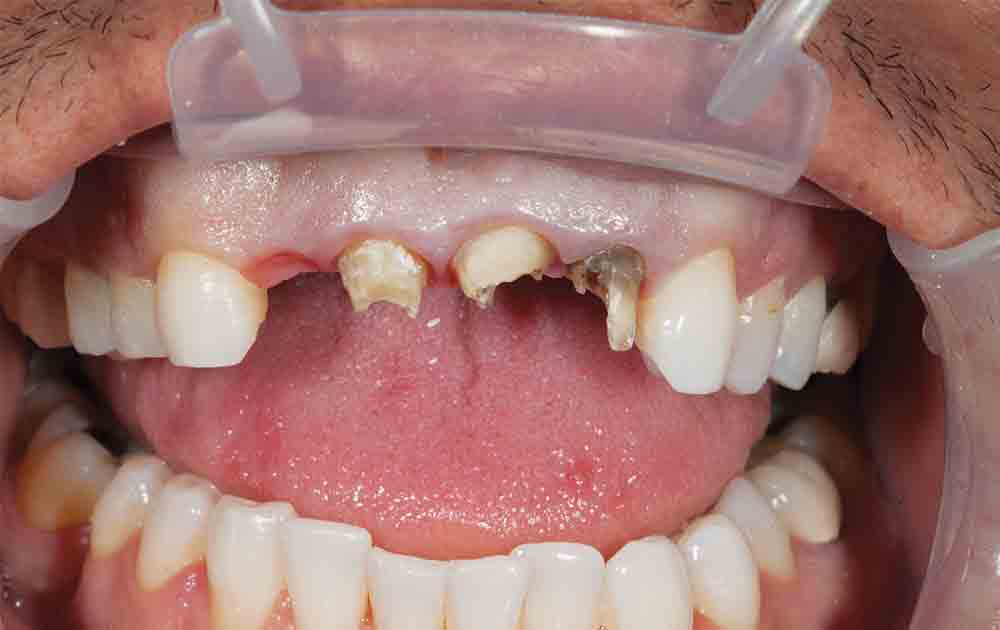 Photo Essay PostandCore Technique with BioTemps® Provisionals