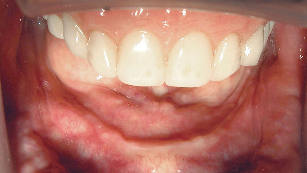 Achieving Reliable Denture Stability: The Need for Implant-Retained ...