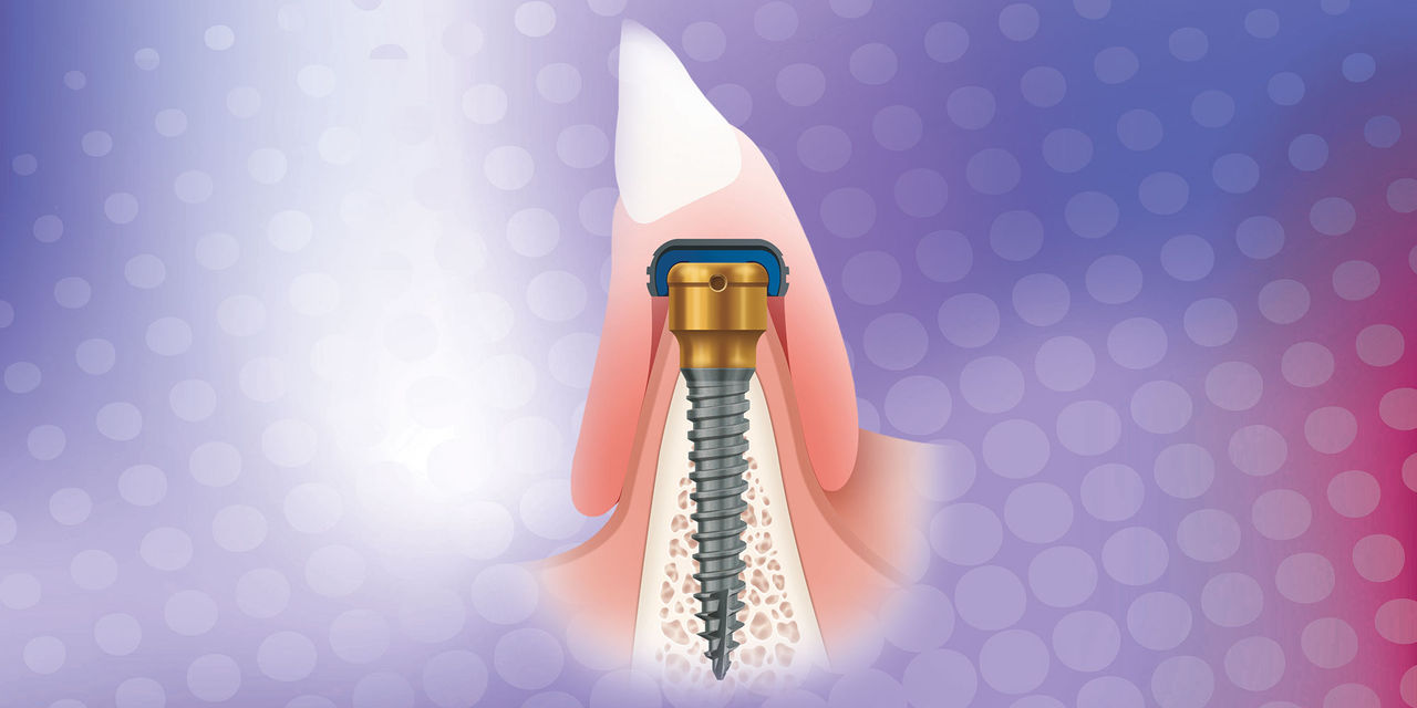 A Better Quality of Life with Implant-Retained Overdentures
