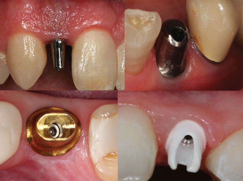 Four separate perspectives of patient's restorations