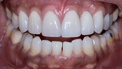 Esthetic Techniques with Anterior Crowns and Veneers