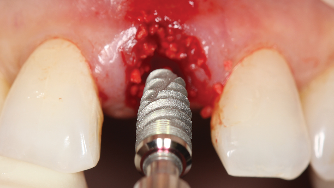 Surgical Placement of Dental Implants: A Restorative-Driven Approach