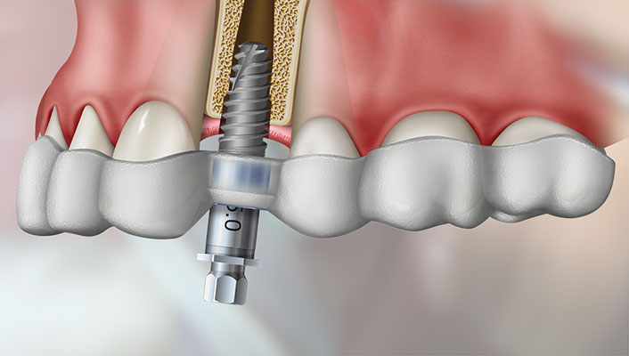 CBCT Guided Surgery Online Course