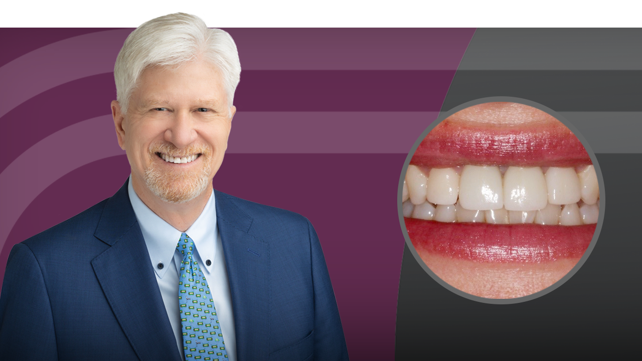 Implant Esthetics: From Extraction to Final Restoration Part 3