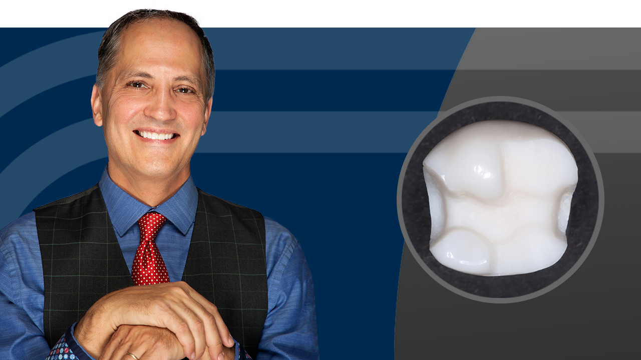 Prevent Enamel Cruelty: Conservative Tooth Preparation for Bonded Indirect Restorations