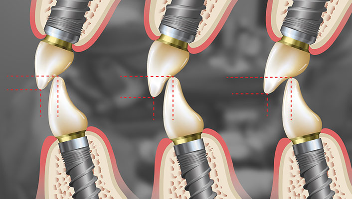 Principles of Implant Occlusion: Part 3 Online Course