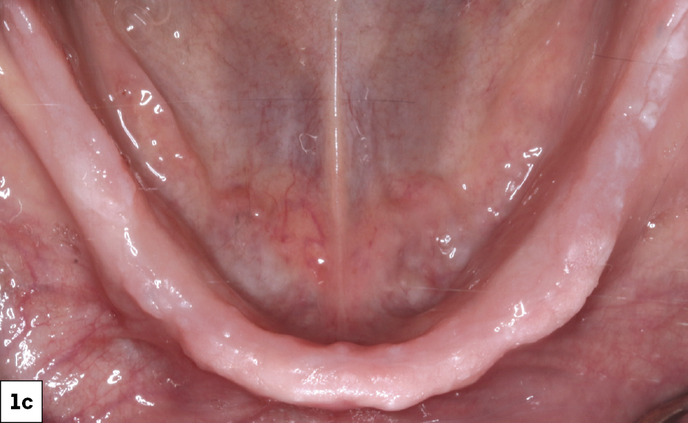 Figure 1c: mandible