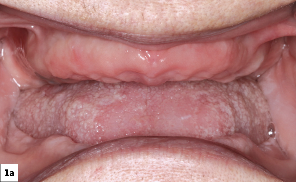 Figure 1a: preoperative edentulous maxilla