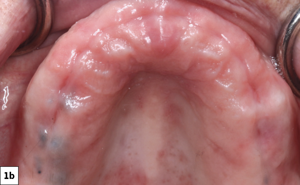 Figure 1b: preoperative edentulous maxilla