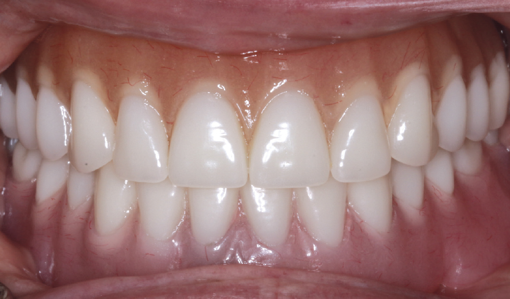 Figure 19: patient's front view of teeth