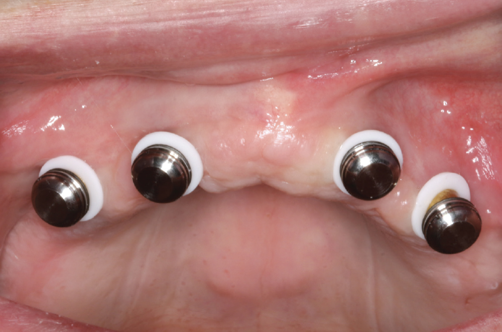 Figure 20: o-shaped blackout rings placed over Locator abutments