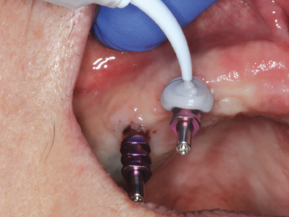 Figure 6: analog impressions using medium and heavy body vinyl polysiloxane (VPS) impression material